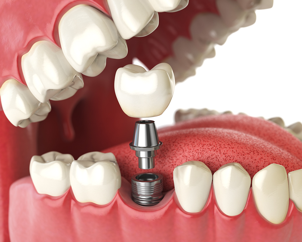 Prótese Dentária e Implantodontia